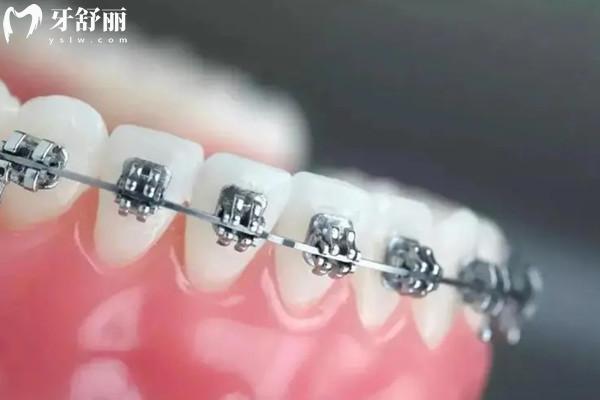 牙齒矯正可以保留虎牙嗎