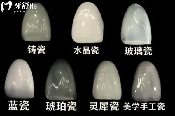 藍瓷貼面vs琥珀瓷貼面哪個好