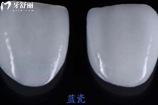 藍瓷貼面vs琥珀瓷貼面哪個好
