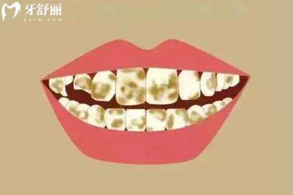 藍瓷貼面vs琥珀瓷貼面哪個好