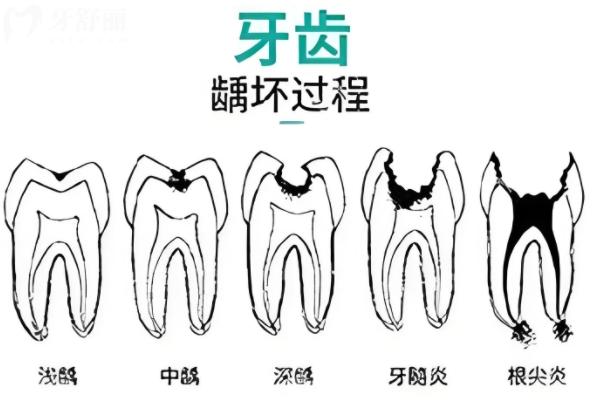齲齒從深到淺發(fā)展歷程