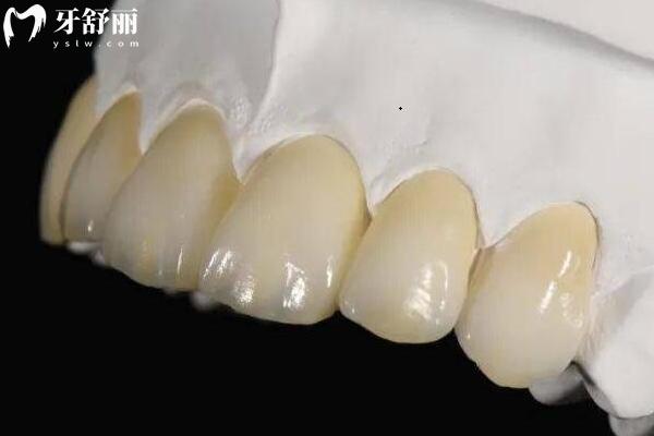 為什么國(guó)產(chǎn)全瓷牙推薦做愛(ài)爾創(chuàng)？性價(jià)比高/生物相容性好/高品質(zhì)材料/耐用性強(qiáng)等