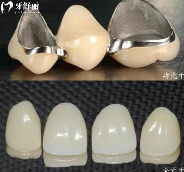 北極星口腔2025年收費標準(透明不黑心):種植牙1680元起