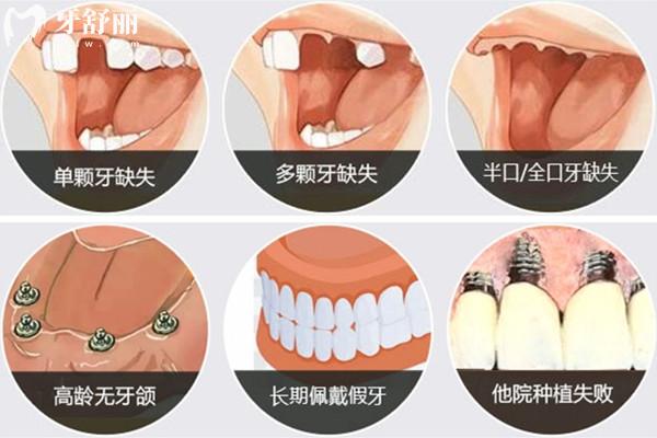 韓國(guó)VitalCore維鈦種植牙簡(jiǎn)介
