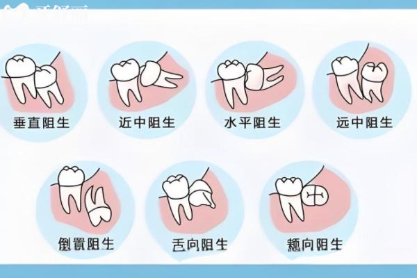 深圳拔一顆智齒需要多少錢？