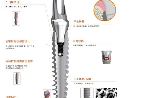 國產(chǎn)種植牙品牌選擇指南