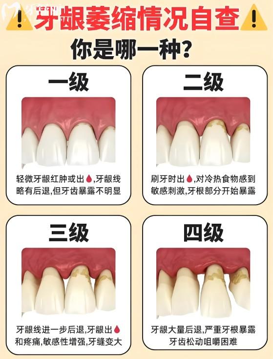 牙齦萎縮怎么治療比較好