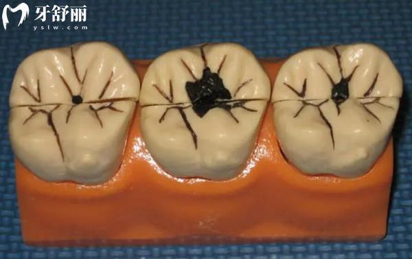爛牙根發(fā)黑腐爛