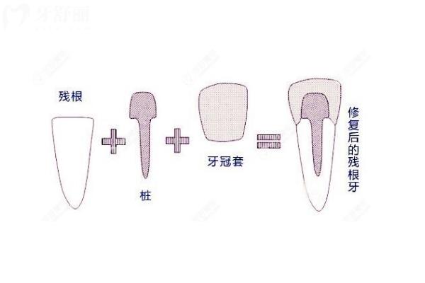 打纖維樁牙齒會牢固嗎？帶您了解纖維樁的原理+優(yōu)勢+注意事項