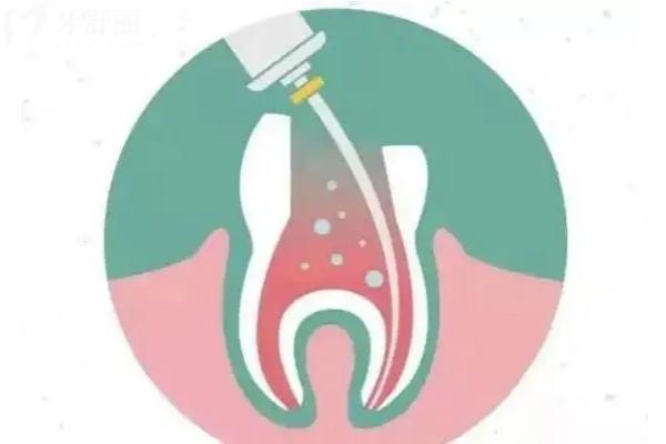 打纖維樁牙齒會牢固嗎？帶您了解纖維樁的原理+優(yōu)勢+注意事項
