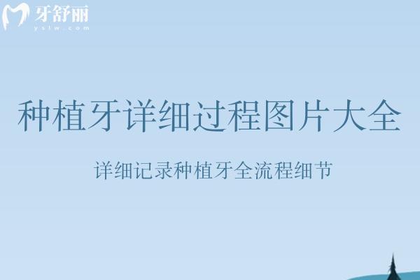 種植牙詳細(xì)過程圖片大全