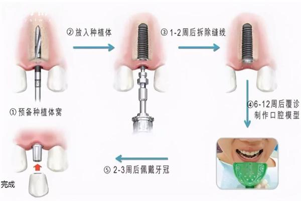 種植牙詳細(xì)過程圖片大全