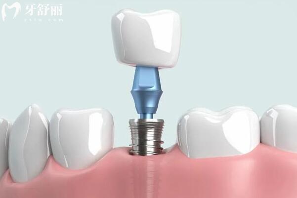 溫州口腔醫(yī)院2025年收費標準全方面解析:種牙