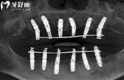 西寧口腔醫(yī)院種植牙價(jià)格表