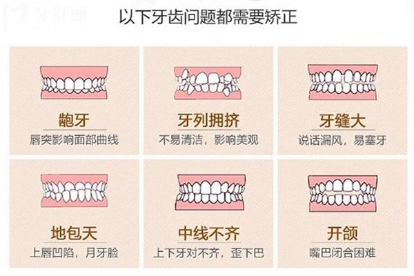每個(gè)孩子都要早期矯正牙齒嗎