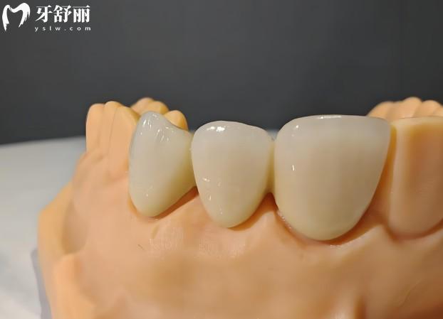 微納熔覆義齒技術(shù)優(yōu)勢