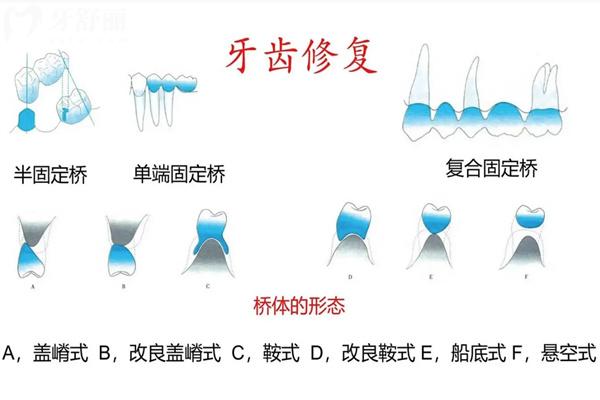 種植牙滿口沒有橋架能種嗎?不用馬瀧橋選連橋冠也行哈!