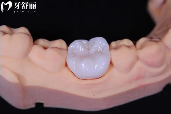 良心牙醫(yī)告訴你為什么不推薦烤瓷牙！一文了解烤瓷牙優(yōu)缺點(diǎn)