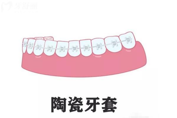 青島隱形牙套矯正價格表在線查詢