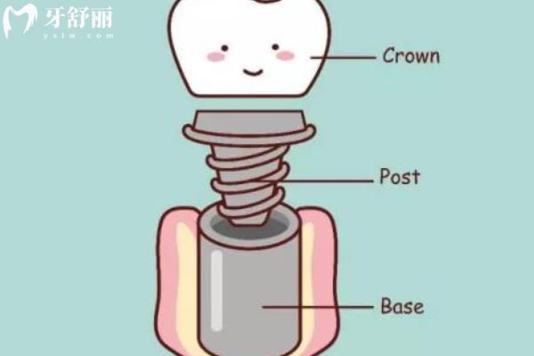 廣州南沙區(qū)種植牙好的牙科排行