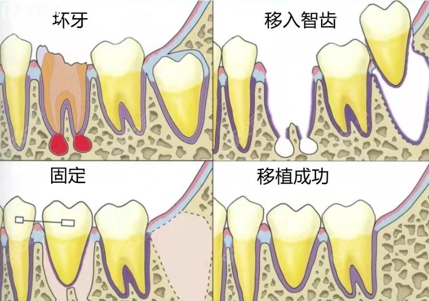 自體牙移植技術(shù)成熟嗎?對(duì)比國(guó)內(nèi)外技術(shù)現(xiàn)狀來(lái)看是比較成熟的!