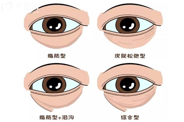 田國靜做眼袋修復(fù)怎樣 田國靜眼修復(fù)技術(shù)特色 田國靜眼修復(fù)價(jià)目表