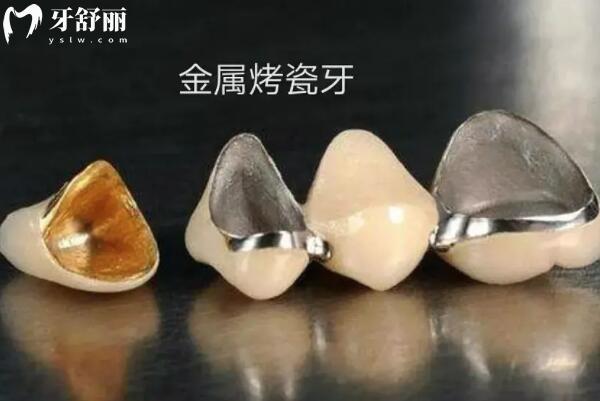 無錫口腔醫(yī)院2025年收費價目表大全(種植牙/正畸/牙冠/補牙/拔牙費用一覽)