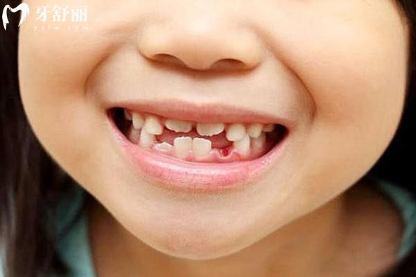 10歲孩子沒換完牙能做矯正嗎