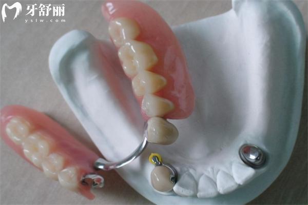 老年人鑲假牙多少錢(qián)一顆