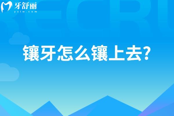 鑲牙怎么鑲上去?分享鑲牙過程圖解圖片大全(含活動(dòng)牙/固定義齒/種植牙)