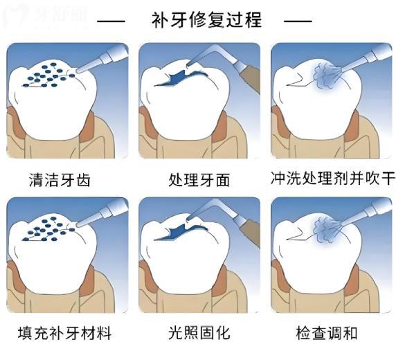 補牙過程