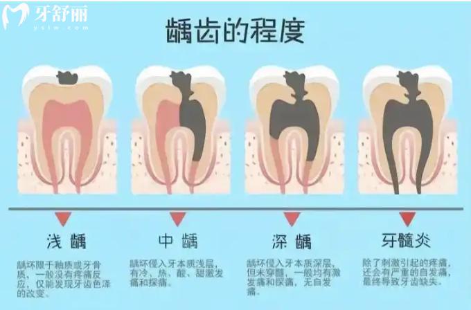 兒童齲齒變化圖一覽 淺齲/中齲/深齲不同類型兒童齲齒治療辦法及費(fèi)用詳解