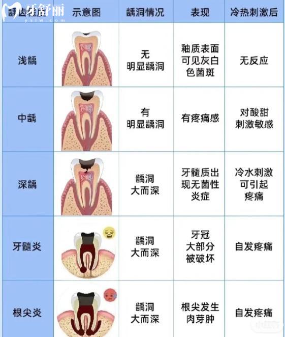 兒童齲齒變化圖一覽 淺齲/中齲/深齲不同類型兒童齲齒治療辦法及費(fèi)用詳解