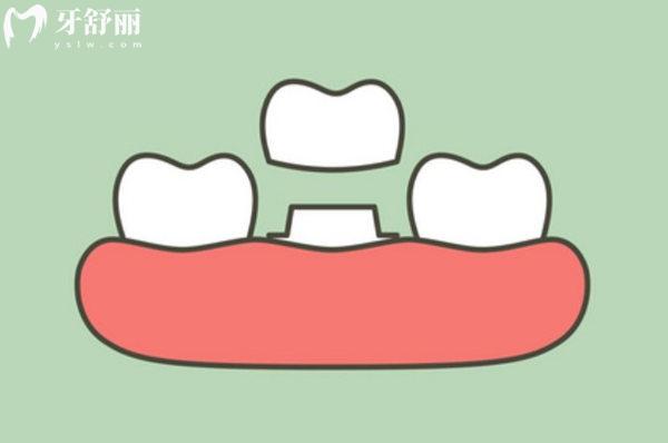 不同價(jià)位全瓷牙有什么區(qū)別