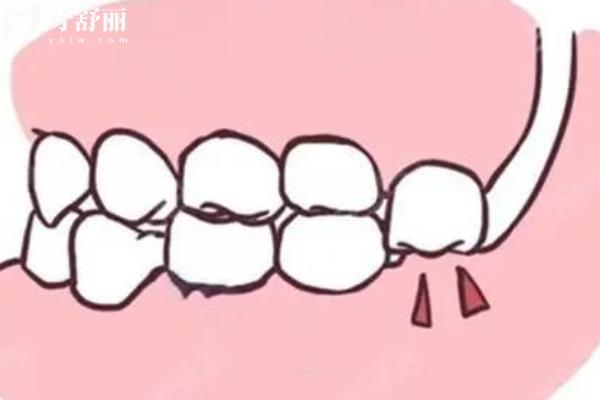 南寧哪里拔智齒便宜點(diǎn)