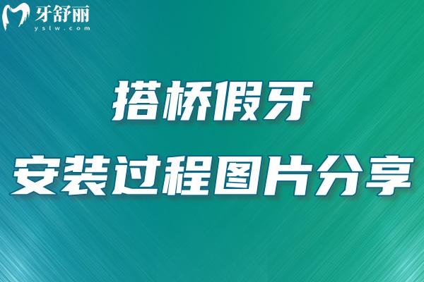 搭橋假牙安裝過程圖片分享