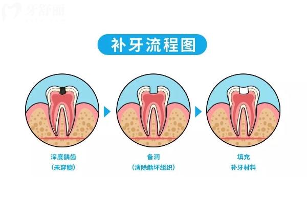 智齒蛀牙是拔好還是補(bǔ)？綜合考慮智齒的生長位置、蛀牙程度、身體狀況等