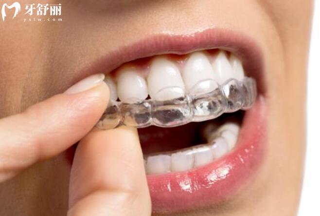 深度對(duì)比：舌側(cè)矯正與隱適美在美觀性、舒適度及適用人群上的核心差異