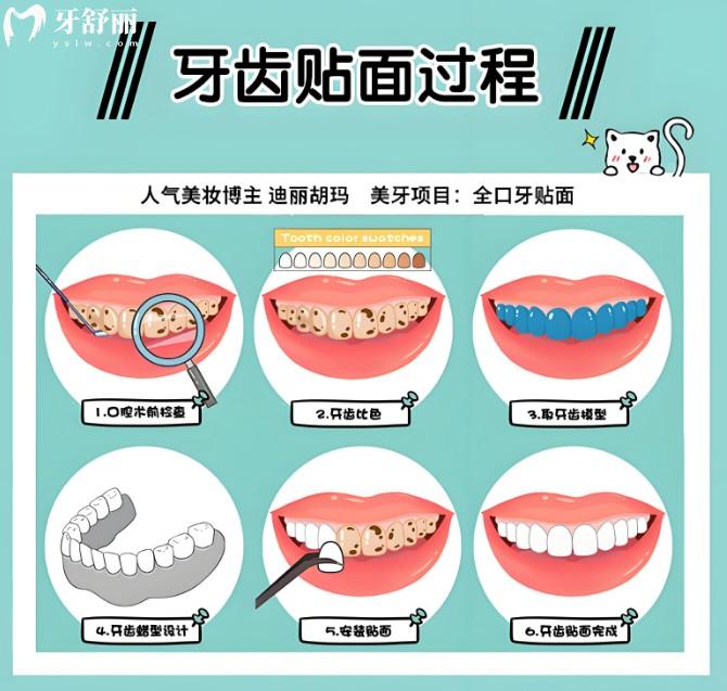 牙貼面制作過程