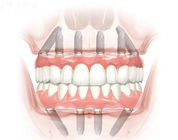 泰安口腔醫(yī)院種植牙價格表