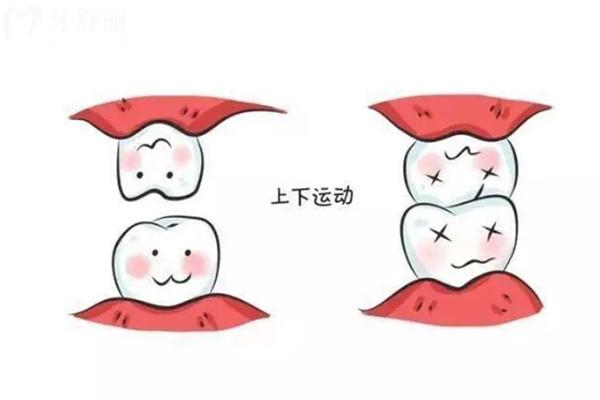 牙齒過(guò)度磨損照片