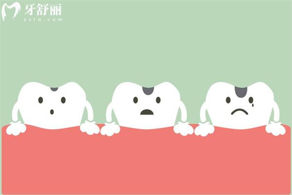 牙齒過(guò)度磨損照片