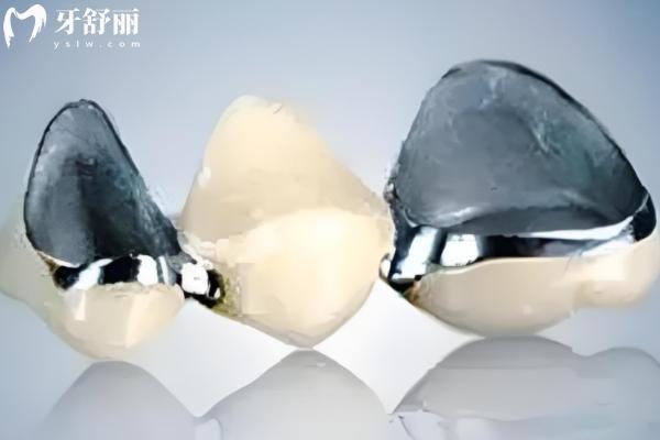 烤瓷牙多少錢一顆價(jià)格表2025