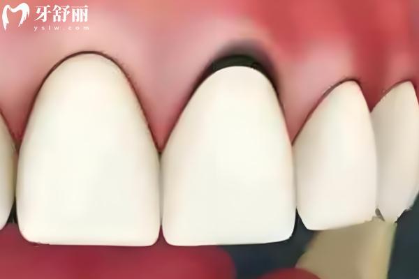 烤瓷牙多少錢一顆價(jià)格表2025
