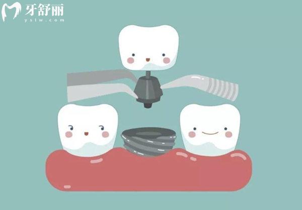 沈陽(yáng)口腔醫(yī)院種植牙多少錢(qián)一顆