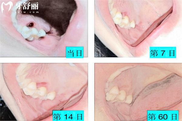 拔智齒洞**過程圖解:拔智齒術后愈合需要多久及注意事項收好