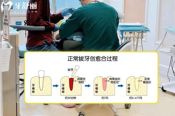 拔智齒洞**過程圖解:拔智齒術后愈合需要多久及注意事項收好