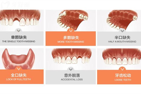 南昌牙科醫(yī)院種植牙價格表