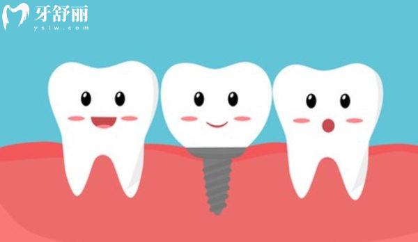 登特斯dentis種植牙的優(yōu)缺點(diǎn)有哪些