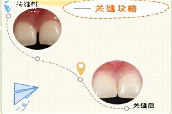 牙齒有縫隙怎么補(bǔ)救 盤點成人牙齒縫隙大怎么修復(fù)的辦法及對應(yīng)原因